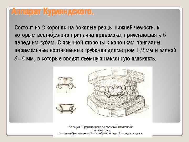 Аппарат Курляндского. Состоит из 2 коронок на боковые резцы нижней челюсти, к которым вестибулярно