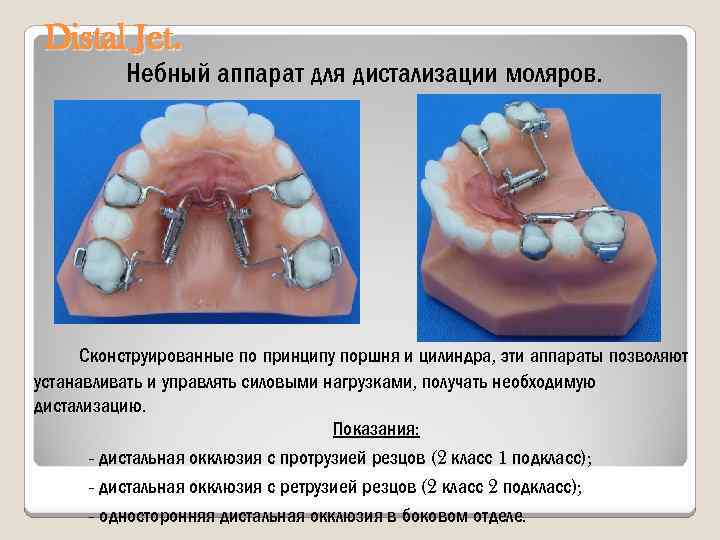 Distal Jet. Небный аппарат для дистализации моляров. Сконструированные по принципу поршня и цилиндра, эти