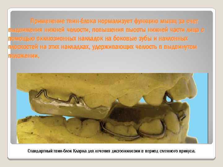 Применение твин-блока нормализует функцию мышц за счет выдвижения нижней челюсти, повышения высоты нижней части