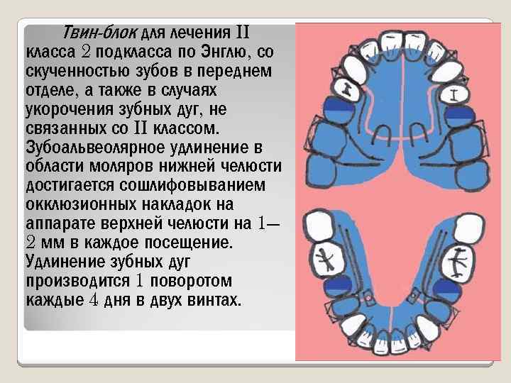 Твин-блок для лечения II класса 2 подкласса по Энглю, со скученностью зубов в переднем