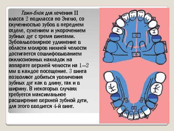 Твин-блок для лечения II класса 2 подкласса по Энглю, со скученностью зубов в переднем