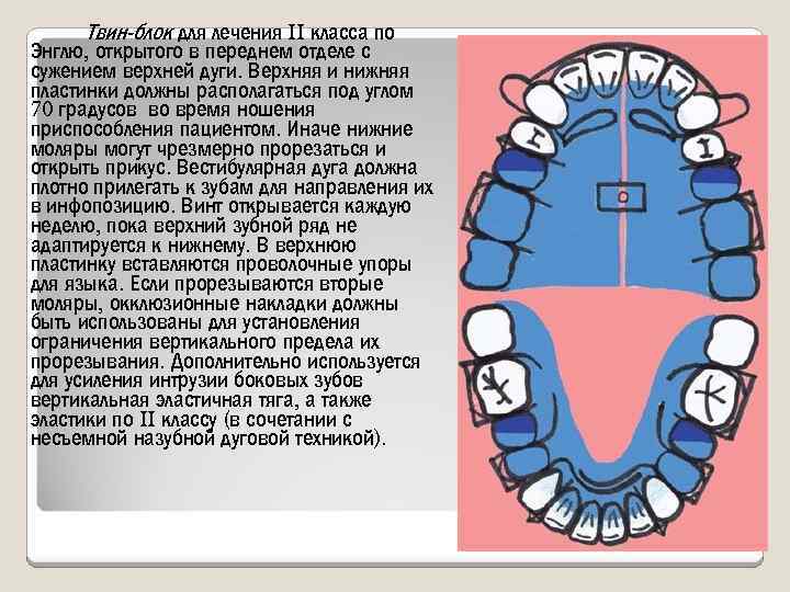 Твин-блок для лечения II класса по Энглю, открытого в переднем отделе с сужением верхней