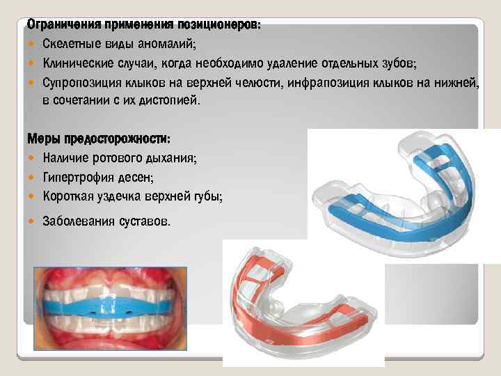 Ограничения применения позиционеров: Скелетные виды аномалий; Клинические случаи, когда необходимо удаление отдельных зубов; Супропозиция