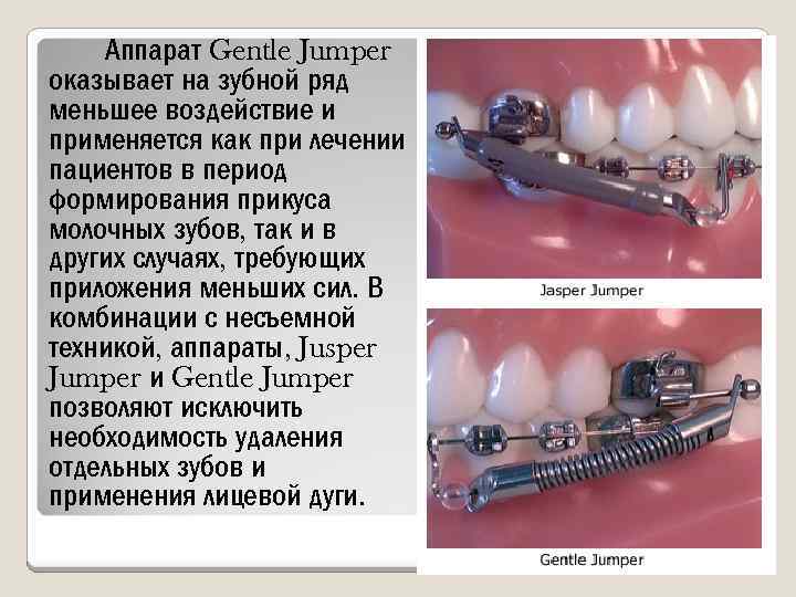 Аппарат Gentle Jumper оказывает на зубной ряд меньшее воздействие и применяется как при лечении