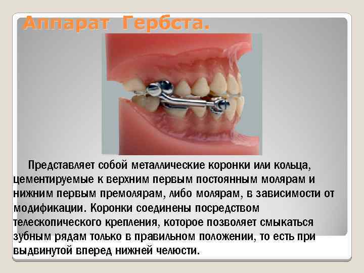 Аппарат Гербста. Представляет собой металлические коронки или кольца, цементируемые к верхним первым постоянным молярам