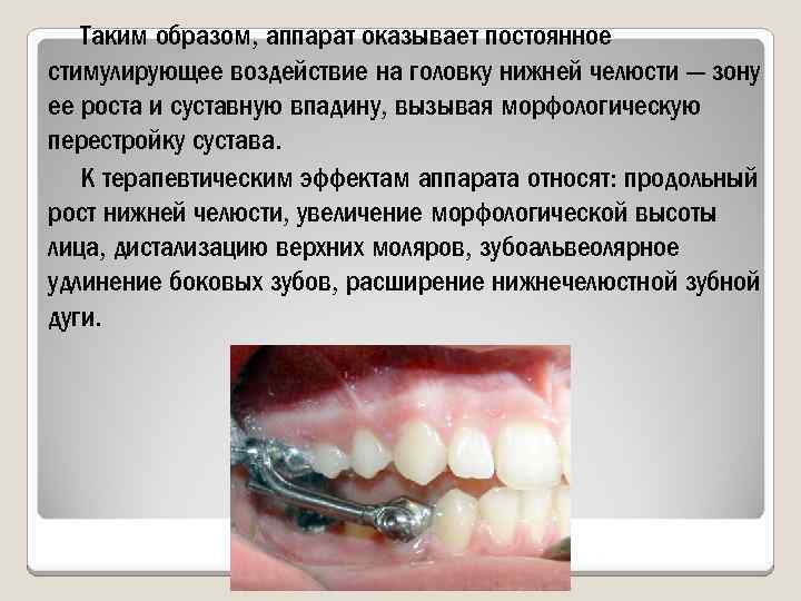 Таким образом, аппарат оказывает постоянное стимулирующее воздействие на головку нижней челюсти — зону ее