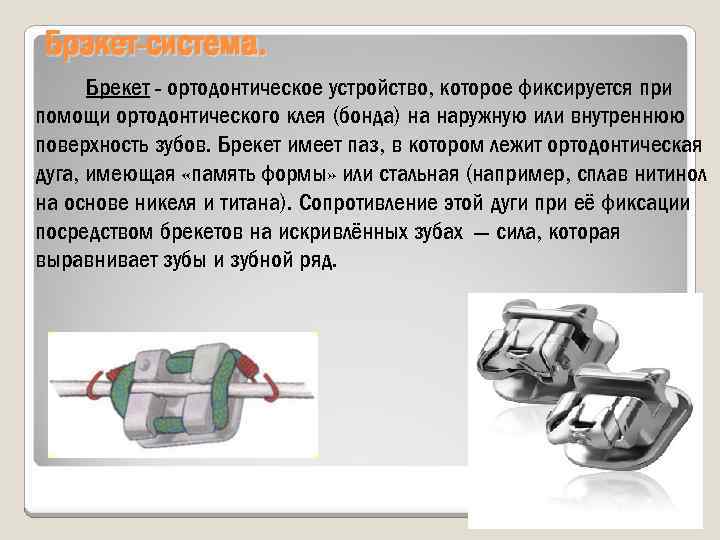 Брэкет-система. Брекет ортодонтическое устройство, которое фиксируется при помощи ортодонтического клея (бонда) на наружную или