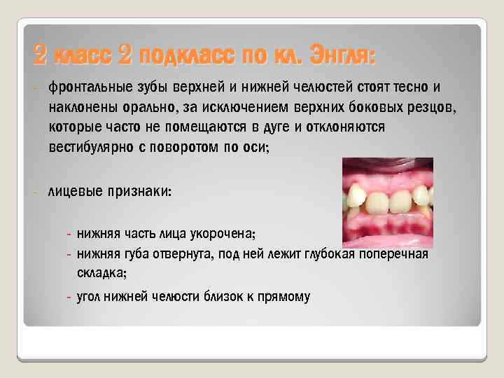 2 класс 2 подкласс по кл. Энгля: фронтальные зубы верхней и нижней челюстей стоят