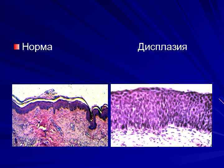 Норма Дисплазия 