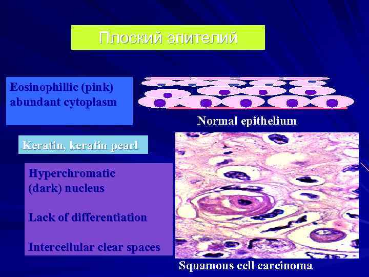 Плоский эпителий Eosinophillic (pink) abundant cytoplasm Normal epithelium Keratin, keratin pearl Hyperchromatic (dark) nucleus