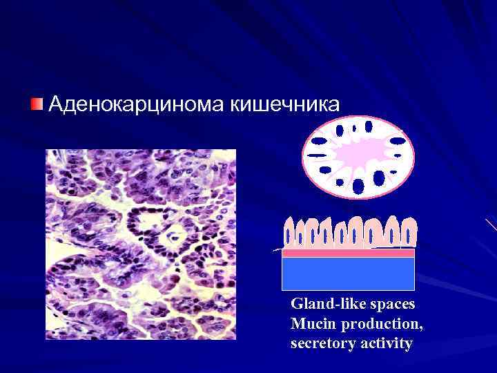 Аденокарцинома кишечника Gland-like spaces Mucin production, secretory activity 
