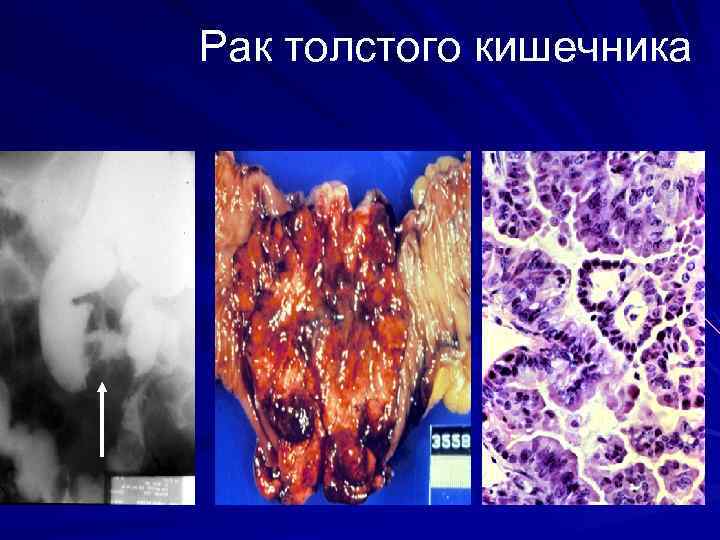 Рак толстого кишечника 