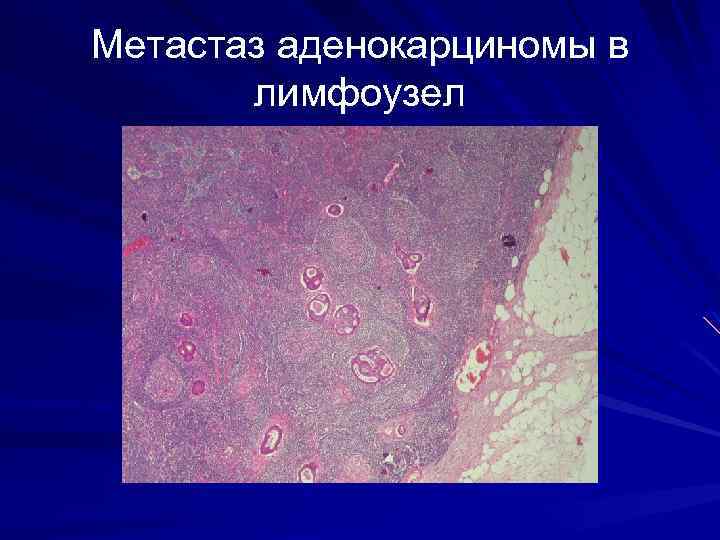Метастаз аденокарциномы в лимфоузел 