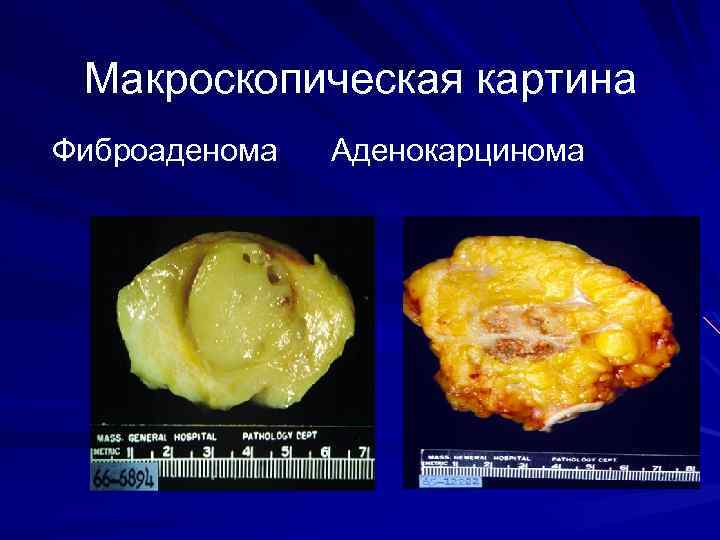 Макроскопическая картина Фиброаденома Аденокарцинома 