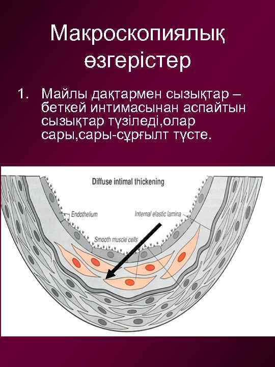 Макроскопиялық өзгерістер 1. Майлы дақтармен сызықтар – беткей интимасынан аспайтын сызықтар түзіледі, олар сары,