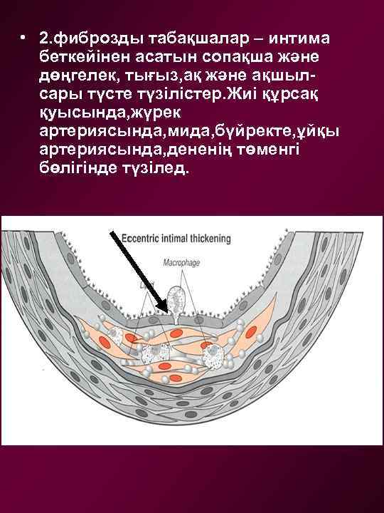  • 2. фиброзды табақшалар – интима беткейінен асатын сопақша және дөңгелек, тығыз, ақ