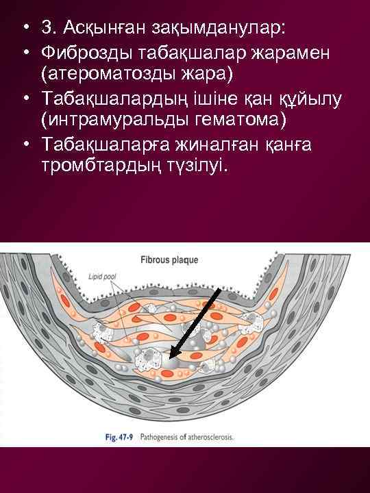  • 3. Асқынған зақымданулар: • Фиброзды табақшалар жарамен (атероматозды жара) • Табақшалардың ішіне
