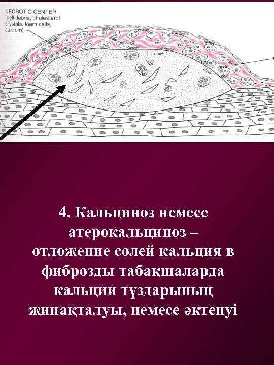 4. Кальциноз немесе атерокальциноз – отложение солей кальция в фиброзды табақшаларда кальции тұздарының жинақталуы,