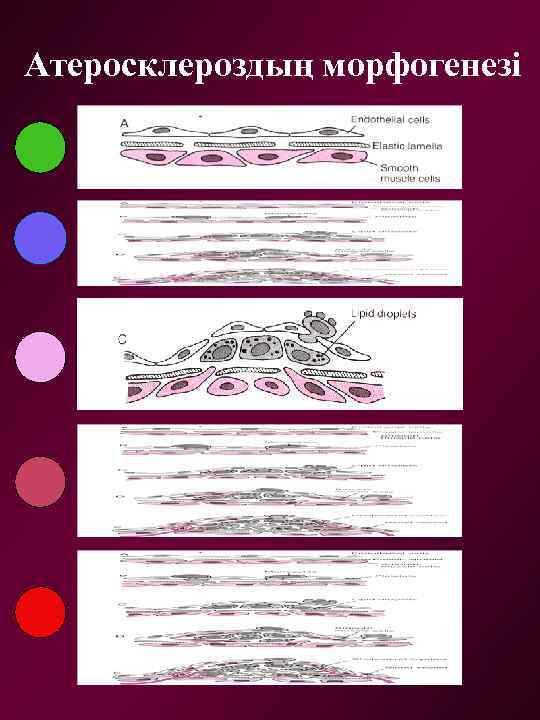 Атеросклероздың морфогенезі 