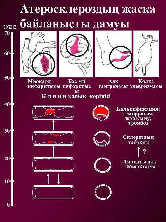 Атеросклероздың жасқа жас байланысты дамуы 70 60 50 Миокард Бас ми инфарктысы инфарктыс ы
