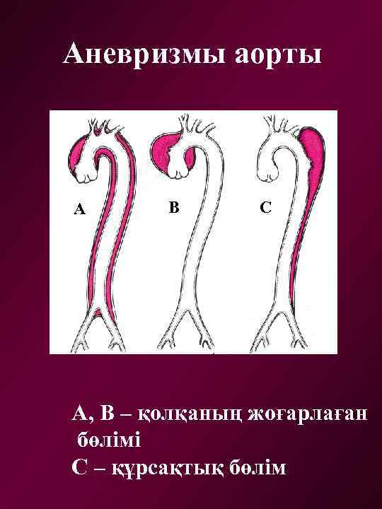 Аневризмы аорты А В С А, В – қолқаның жоғарлаған бөлімі С – құрсақтық