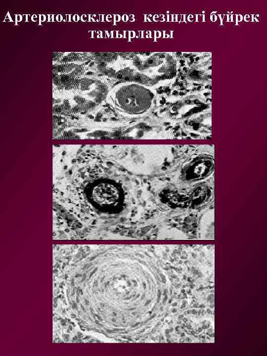 Артериолосклероз кезіндегі бүйрек тамырлары 