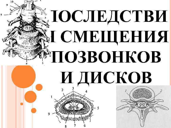 ПОСЛЕДСТВИ Я СМЕЩЕНИЯ ПОЗВОНКОВ И ДИСКОВ 