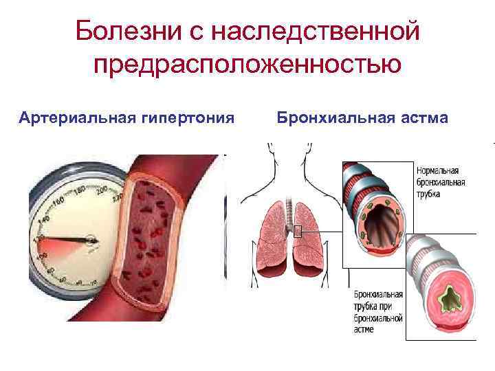 Болезни с наследственной предрасположенностью Артериальная гипертония Бронхиальная астма 