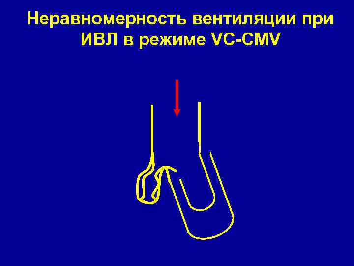 Неравномерность вентиляции при ИВЛ в режиме VC-CMV 