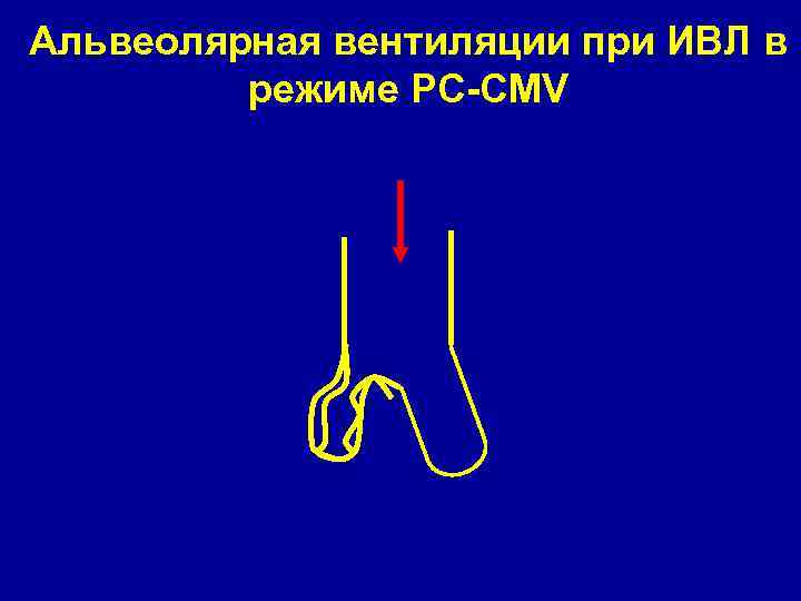 Альвеолярная вентиляции при ИВЛ в режиме РC-CMV 