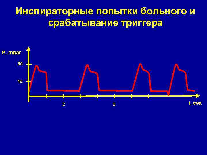 Инспираторные попытки больного и срабатывание триггера P, mbar 30 15 2 5 t, сек
