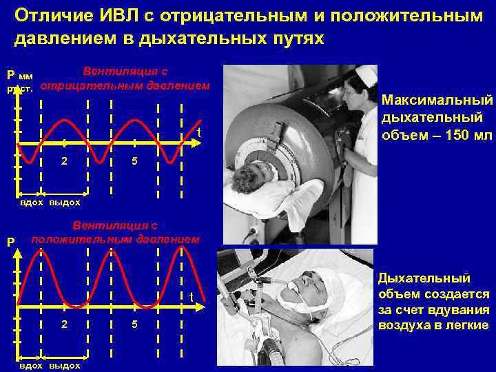 Отличие ИВЛ с отрицательным и положительным давлением в дыхательных путях Вентиляция с рт. ст.