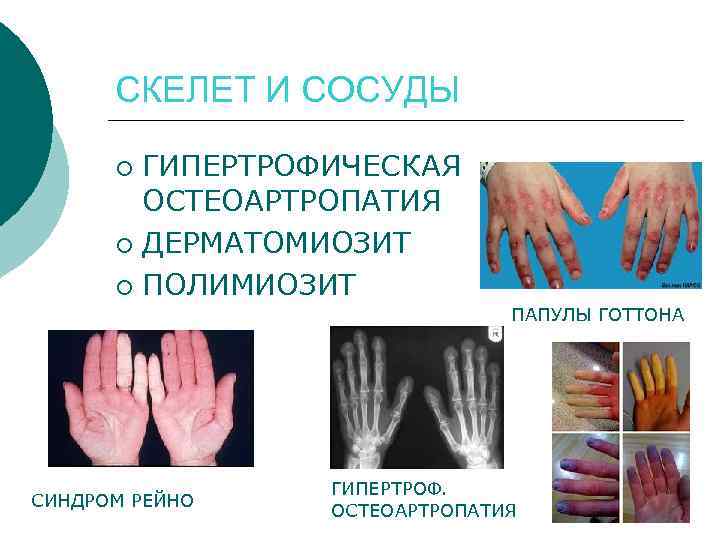 СКЕЛЕТ И СОСУДЫ ГИПЕРТРОФИЧЕСКАЯ ОСТЕОАРТРОПАТИЯ ¡ ДЕРМАТОМИОЗИТ ¡ ПОЛИМИОЗИТ ¡ ПАПУЛЫ ГОТТОНА СИНДРОМ РЕЙНО