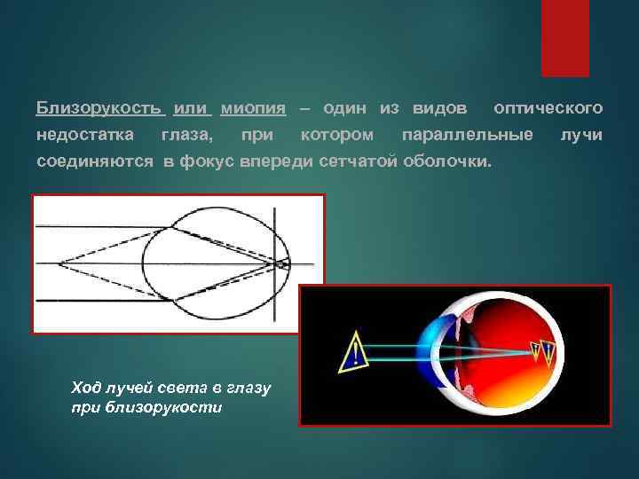 Близорукость или миопия – один из видов оптического недостатка глаза, при котором параллельные лучи
