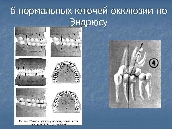 6 нормальных ключей окклюзии по Эндрюсу 