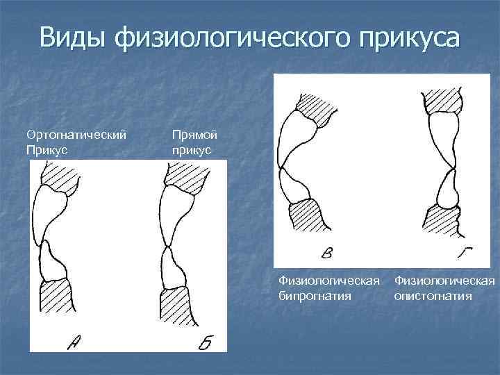 Виды физиологического прикуса Ортогнатический Прикус Прямой прикус Физиологическая бипрогнатия Физиологическая опистогнатия 