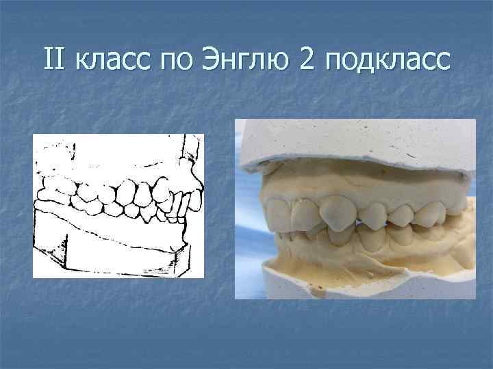 II класс по Энглю 2 подкласс 