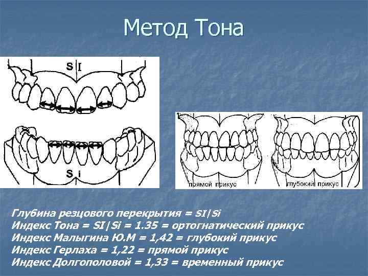 Метод Тона Глубина резцового перекрытия = SI|Si Индекс Тона = SI|Si = 1. 35