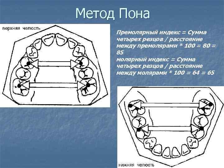 Метод Пона Премолярный индекс = Сумма четырех резцов / расстояние между премолярами * 100