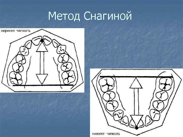 Метод Снагиной 