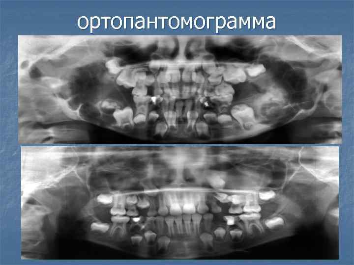 ортопантомограмма 