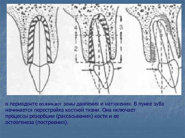 в периодонте возникают зоны давления и натяжения. В лунке зуба начинается перестройка костной ткани.