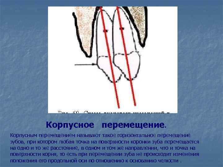 Перемещением называют. Горизонтальное перемещение зубов. Корпусное перемещение зубов. Корпусное перемещение зуба. Корпусное перемещение зубов в ортодонтии.