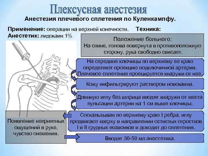 Анестезия плечевого сплетения по Куленкампфу. Применение: операции на верхней конечности. Техника: Анестетик: лидокаин 1%