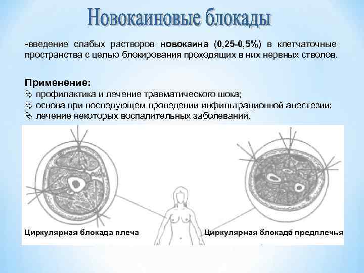 -введение слабых растворов новокаина (0, 25 -0, 5%) в клетчаточные пространства с целью блокирования