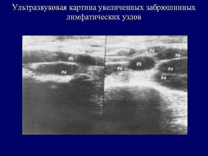 Ультразвуковая картина увеличенных забрюшинных лимфатических узлов 