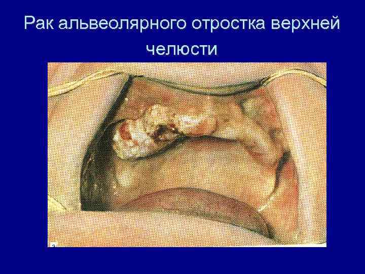 Рак альвеолярного отростка верхней челюсти 
