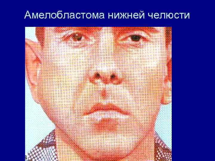 Амелобластома нижней челюсти 