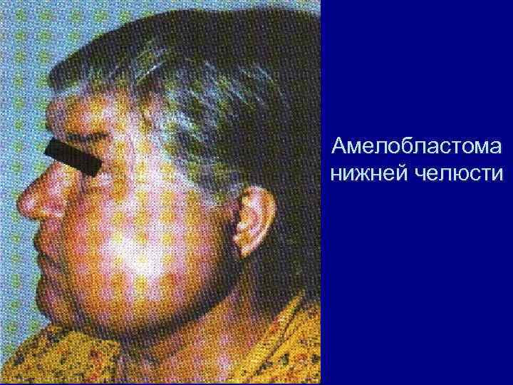 Амелобластома нижней челюсти 