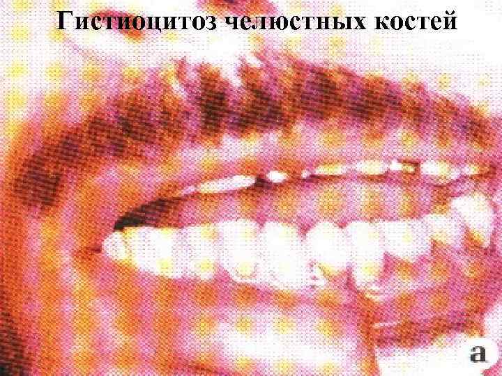 Гистиоцитоз челюстных костей 